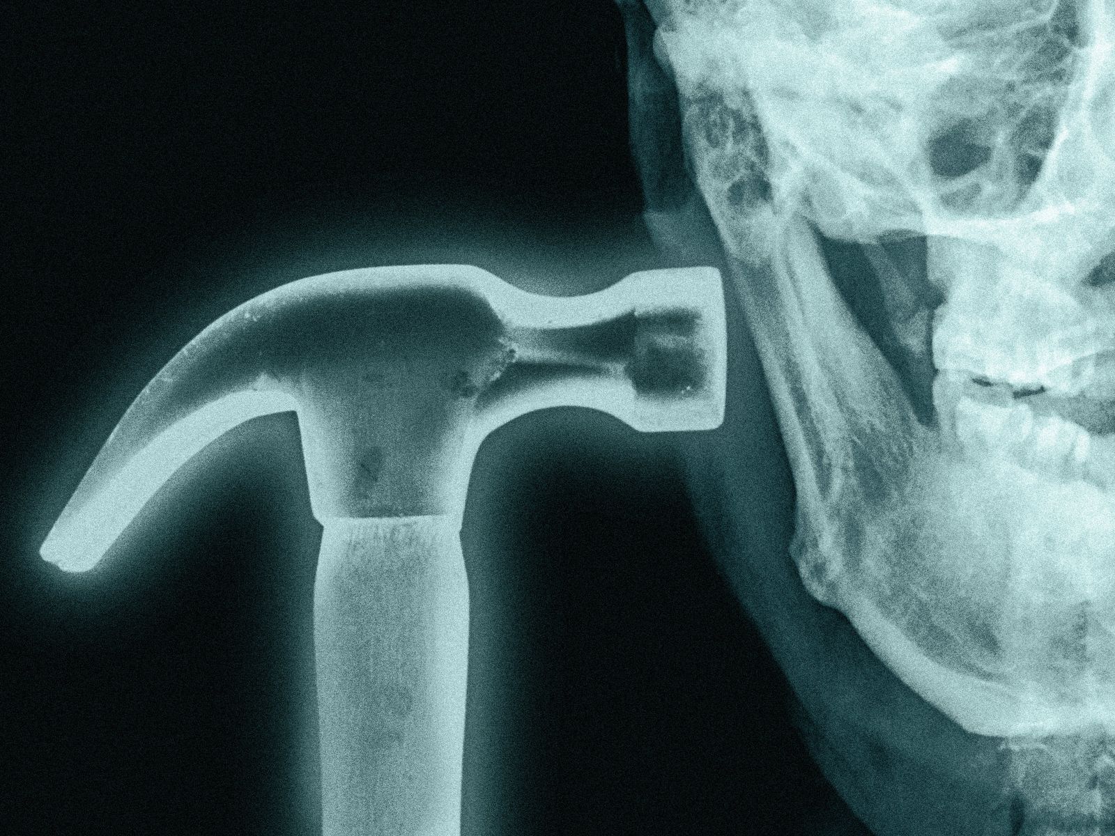 What is Bonesmashing? Inside the Extreme Looksmaxxer Technique